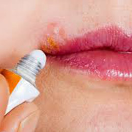 Cold Sores