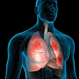 Pneumonia