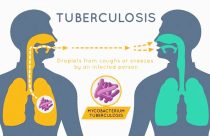 Nepal plans to eradicate Tuberculosis by 2050